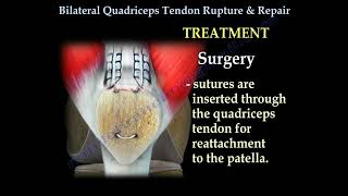 Bilateral Quadriceps Tendon Rupture & Repair   Everything You Need To Know   Dr  Nabil Ebraheim