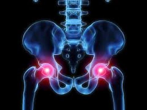 Osteoarthritis of the Hip can be treated using Stem Cell's in the USA!