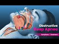 What Is Obstructive Sleep Apnea OSA Symptoms And Treatment 3D Guide