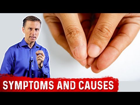 Iron Deficiency Symptoms and Causes of Anemia – Dr.Berg