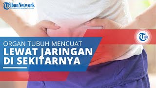 Hernia, Organ Dalam Tubuh Menekan dan Mencuat melalui Jaringan di Sekitarnya yang Lemah
