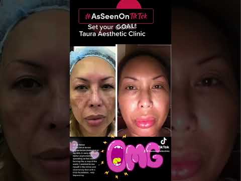My personal experience with darker pigmentation (melasma) on my face.
