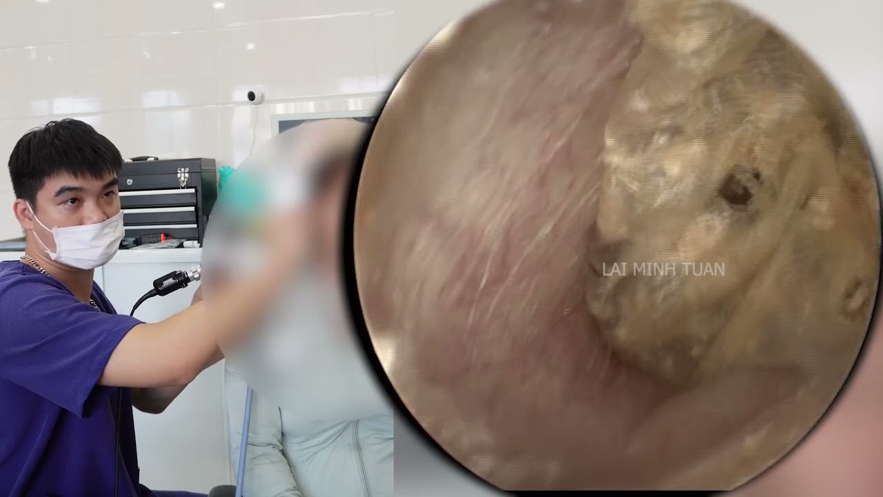 🌀耳掃除 | 超薄型耳垢シュリンク | プロによる耳垢除去と心地よい音