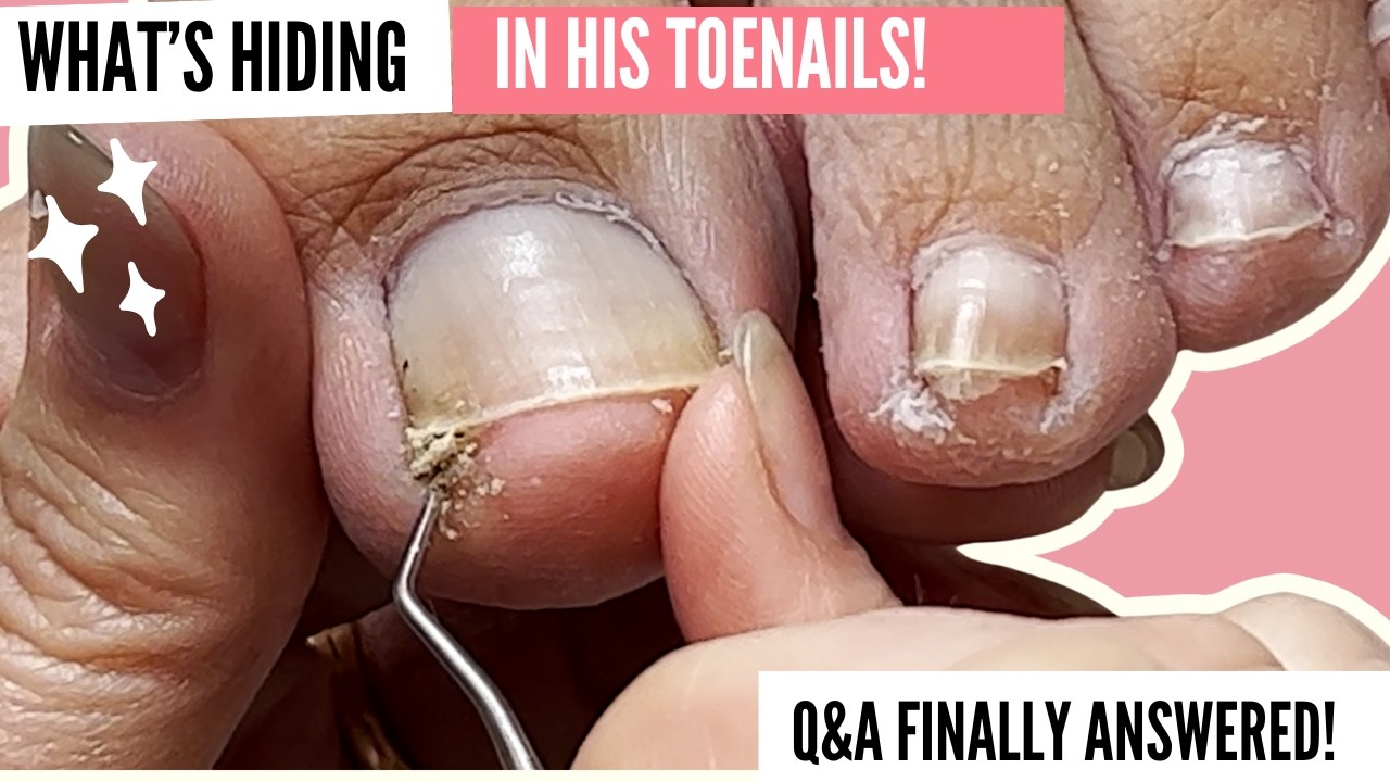 The Ultimate Ingrown Toenail & Pedicure Compilation | Q&A + Fun Stories with Mr. Meticulous! 👣