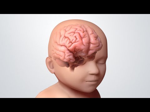 ¿Qué es la epilepsia en los niños?