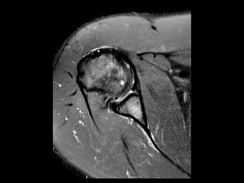 SLAP tear with fibroosseous Bankart lesion
