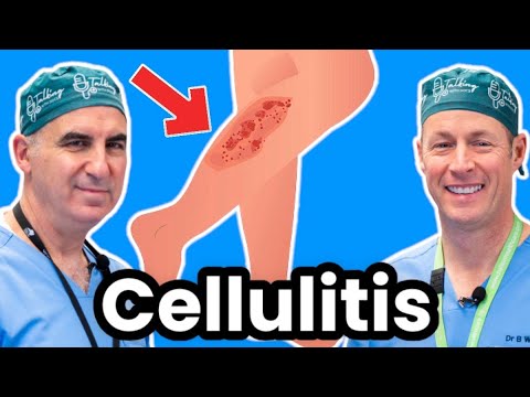 Cellulitis Explained By Infectious Disease Doc. Red, Sore And Swollen