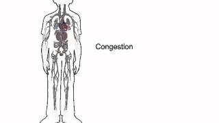 How heart failure causes fluid accumulation - www.heartfailurematters.org