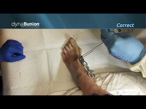 DynaBunion 4D Minimal Incision Lapidus System - Cadaveric Surgical Demo