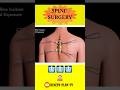 Spine Surgery 3D Animation Video Shorts Ytshorts Health