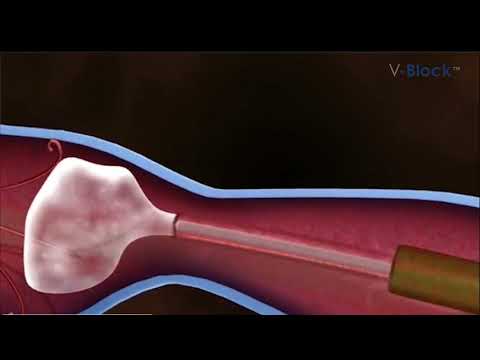 Treatment of large saphenous veins using the V-Block procedure