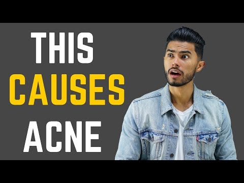 5 SURPRISING Causes of Acne (And How To Fix It!)