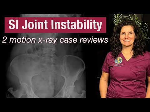 Sacroiliac joint instability seen on motion x-ray- 2 case reviews