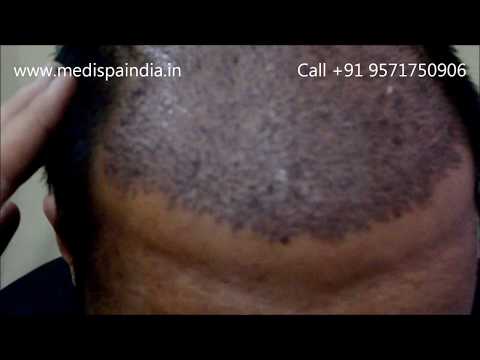 Best Hair Transplant in India Delhi Jaipur procedure by Dr.Suneet soni @ medispa