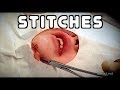 LIVE STITCHES On A Moving Child Dr Paul