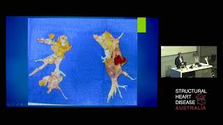 Pulmonary Endarterectomy for Chronic Thromboembolic Pulmonary Hypertension – Prof David McGiffin