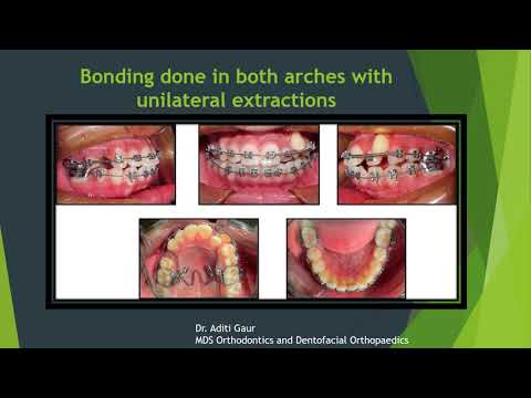 Class I malocclusion with crowding pptx