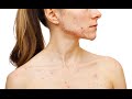 L120Y | CYSTIC ACNE | BLOOD SUGAR ...