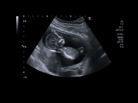 Beautiful Ultrasound Video of 14 Weeks Pregnancy | Baby Girl