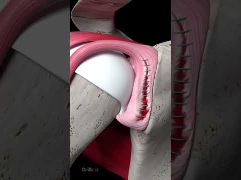 Shoulder Labrum Tear Repair (Animation)