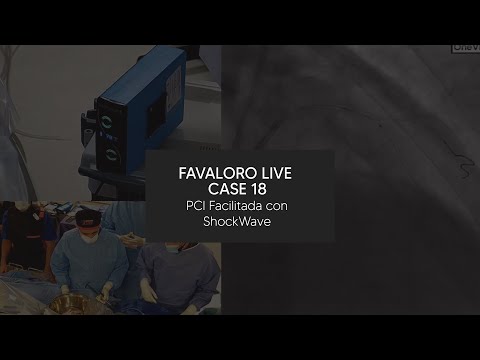 Favaloro Live Case N° 18 - PCI Facilitada con ShockWave