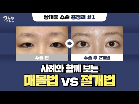 눈 성형 전 이 영상만 확인하면 OK! 성공적인 눈 성형을 위한 가이드!