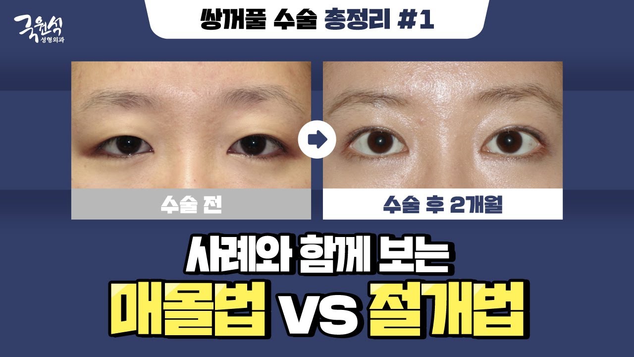 눈 성형 전 이 영상만 확인하면 OK! 성공적인 눈 성형을 위한 가이드!