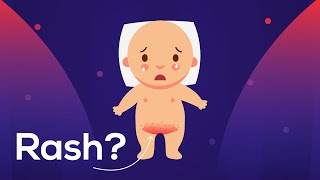 Diaper Rash: Due to Baby Urine or Fungus? & Helpful tips to cure