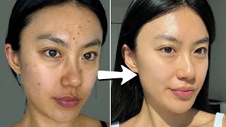 how I cleared my skin in a week with $0