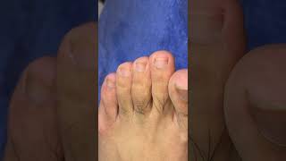 Ep_8154 Ingrown toenail removal 👣 You don't have to cut your toenails like me 😄 (clip from Thailand)