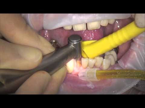 Bausch Fleximeter-Strips