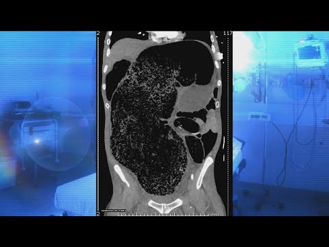 Man’s Extreme Constipation Nearly Kills Him