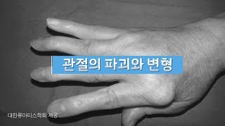 류마티스관절염