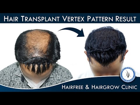 Best Hair Transplant Result | Grade 3-4 Baldness Vertex Pattern | HFHG Clinic Pune(Pimple Gurav)