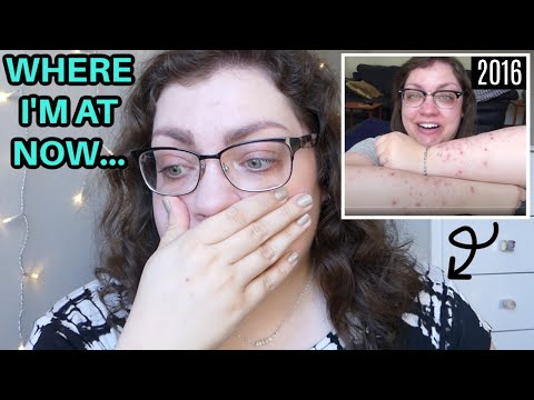 Dermatillomania & Body Image | End of Year Update (2020)