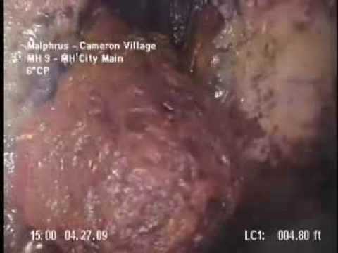 Fotografia di un parassita in un cervello Quale helminths in unaringa