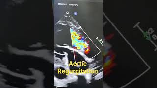 Download lagu Aortic Regurgitation #AR #cardiology mp3