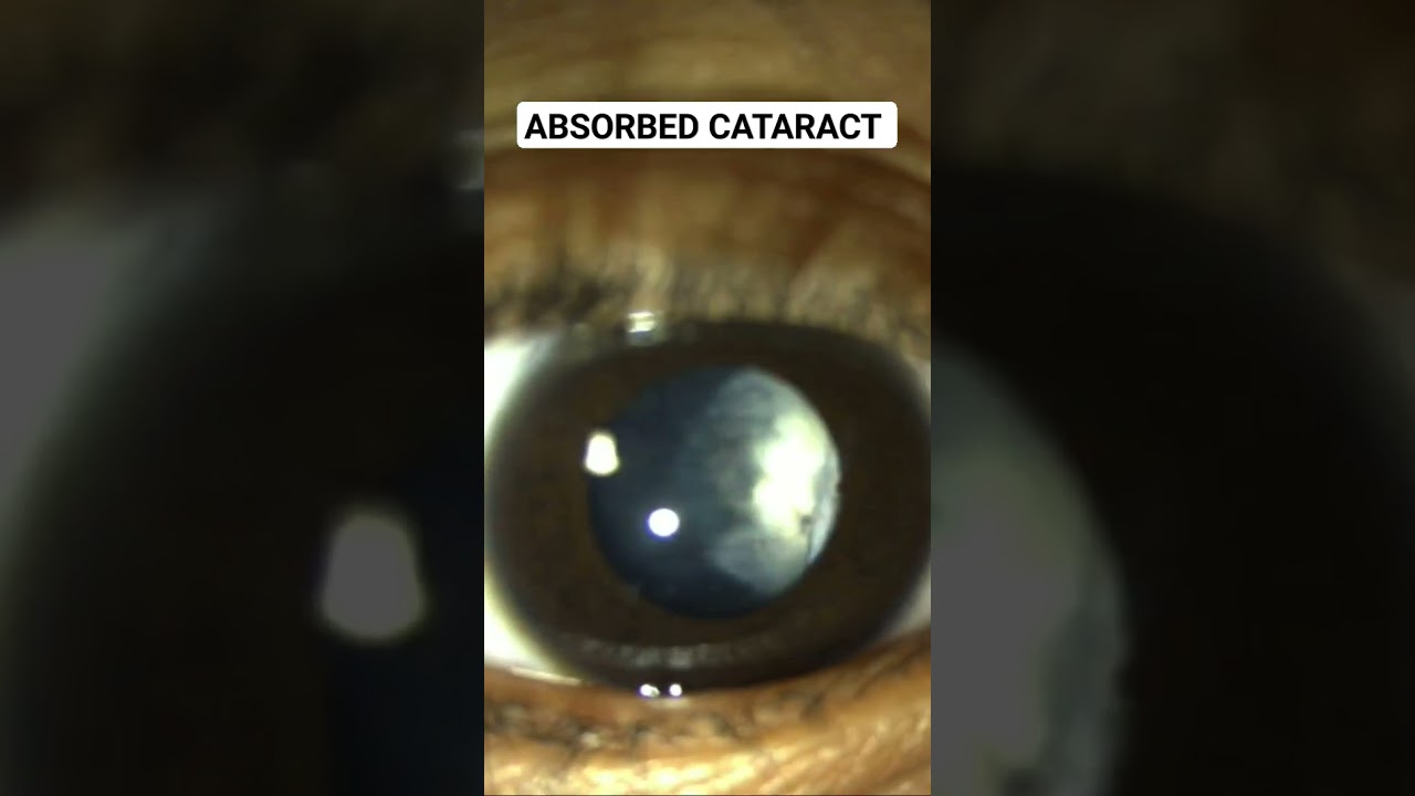 Absorbed cataract