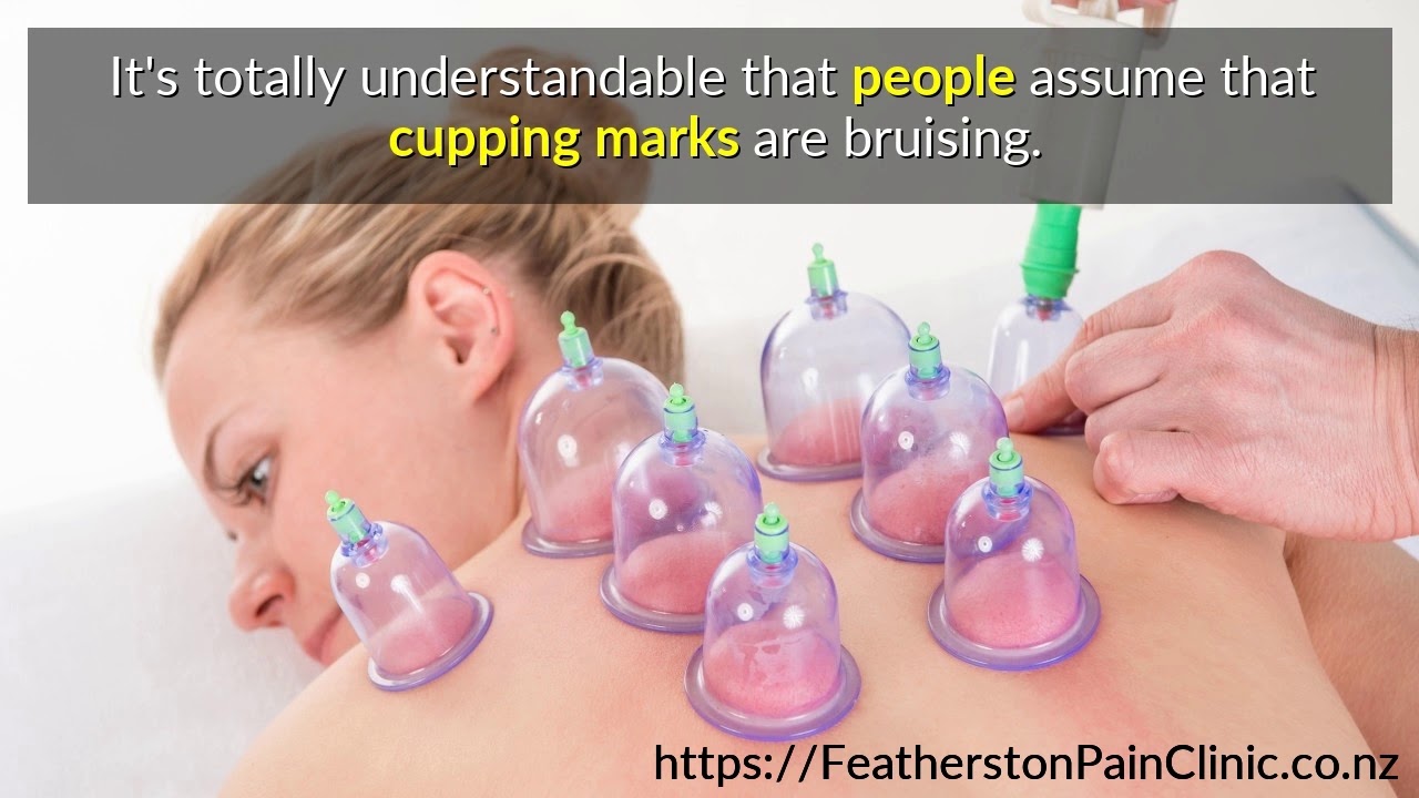 3 Cupping Myths Debunked