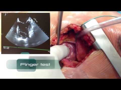 Endovascular Aortic Repair: The Transapical Access