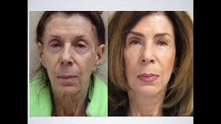 Unlocking Timeless Beauty: Michelangelo Facial Fillers - 100% Natural Results!