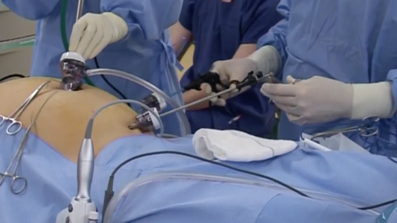 Laparoscopic Right Hemicolectomy