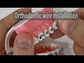 How to install & ligate orthodontic wire with elastic ligature and ss twisted preformed ligature