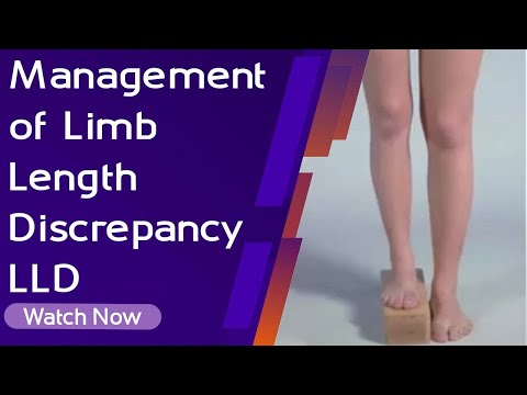 Management of Limb Length Discrepancy