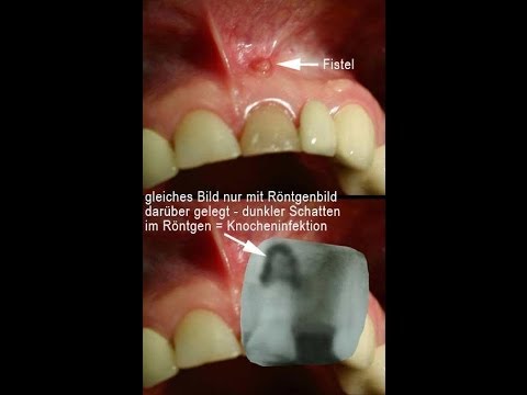 Hip Replacement in Shitomir Meditsina.bol im Schultergelenk