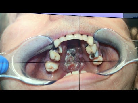 Warning signs of oral cancer