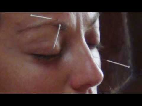 El arte sanador de la Acupuntura