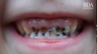 Every 10 minutes a child in England has a rotten tooth removed in hospital