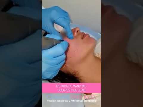 Tratamientos estéticos con Dermapen en Bogotá - Dra. Claudia Toro médica estética