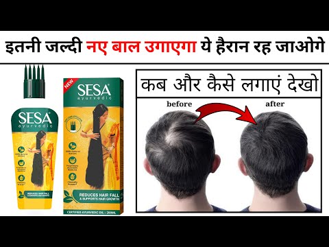 Sesa Hair Oil Review | sesa hair oil results | how to use sesa hair oil